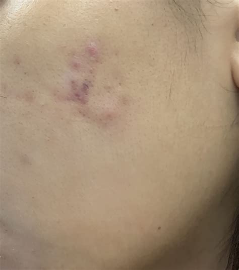 How Do I Get Rid Of Red Acne Scars Due To Active Outbreaks Photo Human