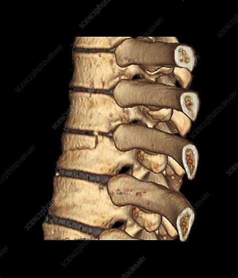 Fractured Spine 3d Ct Scan Stock Image M3301725 Science Photo