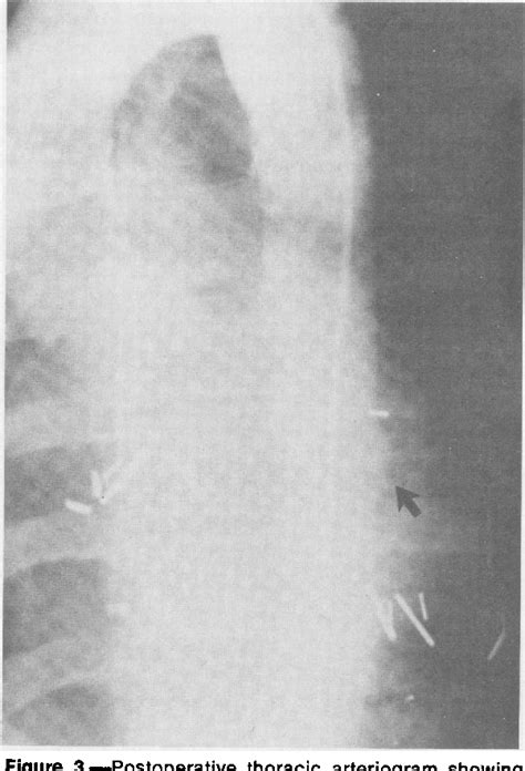 Figure 3 From Gunshot Penetrating Injuries Of The Descending Thoracic