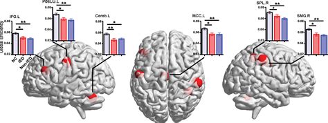 Decreased Network Efficiency In Benign Epilepsy With Centrotemporal