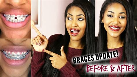 Braces Update Before And After Youtube