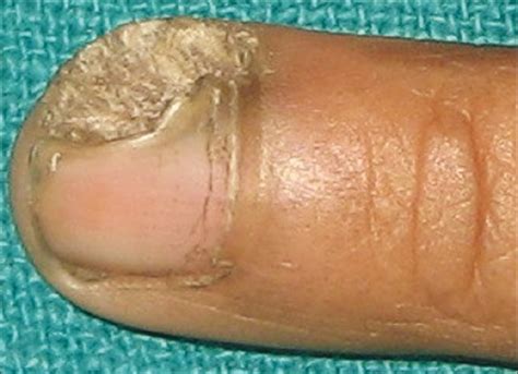 partial nail avulsion nail ftempo