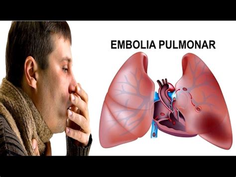 Embolia Pulmonar Sintomas Tratamentos E Causas Youtube