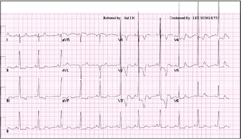 Leads avf and avl should be pointing upwards, as that is the normal direction of cardiac impulse flow. Twelve-lead EKG shows right-axis deviation, ST-segment ...