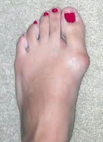 It is the formation of fibrous tissue around foot blisters look like bubbles or painful lump on bottom of foot under the skin. Is your big toe sore and stiff? Is there a lump protruding ...