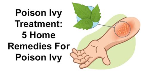 How To Treat Poison Ivy Blisters