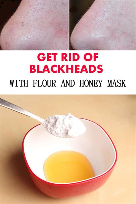 The Most Effective Homemade Remedies To Get Rid Of Blackheads All For