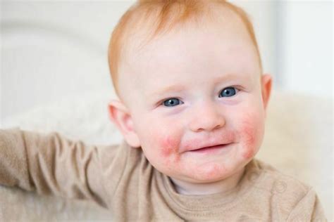 Dermatita Atopica La Bebelusi Cum O Recunoastem Si Ce Putem Face