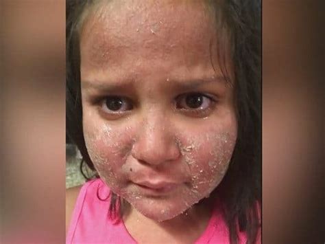 Mom Warns Against Using Sunscreen That Burned Daughter Photos