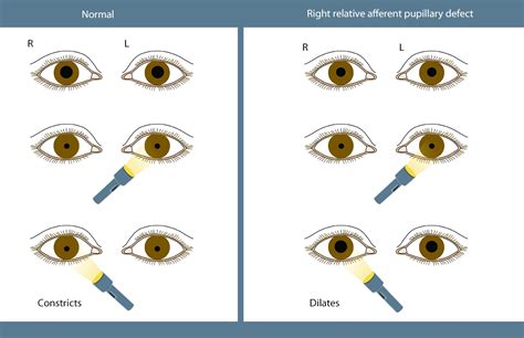 Normal Pupil Size Chart