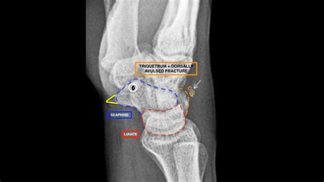 Wrist X Ray Interpretation Osce Guide Geeky Medics
