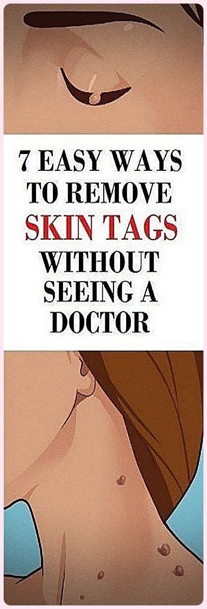 7 easy ways to remove skin tags without visiting a doctor skin tag removal skin tag skin