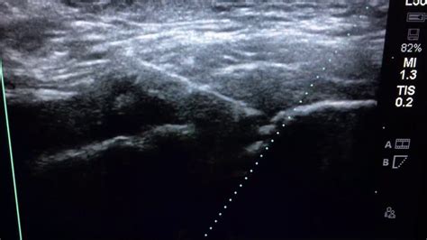 Ultrasound Guided Pubic Symphysis Injection For Osteitis