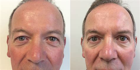 Eyelid Surgery Blepharoplasty Traditional Vs Laser Blepharoplasty