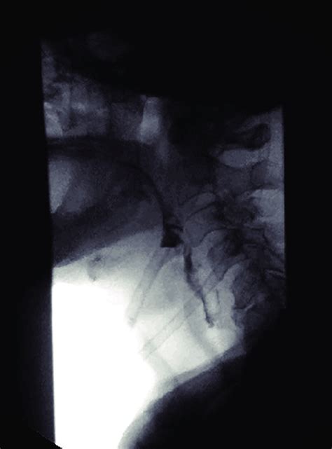 Modified Barium Swallow Showing Deep Laryngeal Penetration With Frank