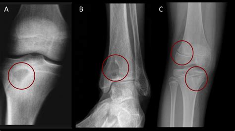 Osteomyelitis X Ray Foot