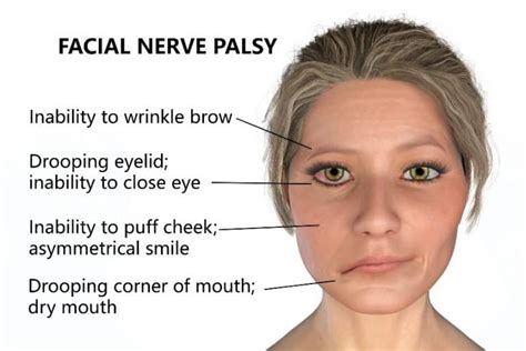 Why Is Facial Paralysis Surgery A Good Choice For Patients Best
