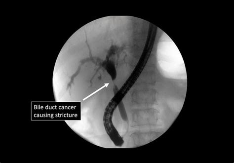 Bile Duct Cancer Treatment In Singapore Ls Lee Surgery Clinic
