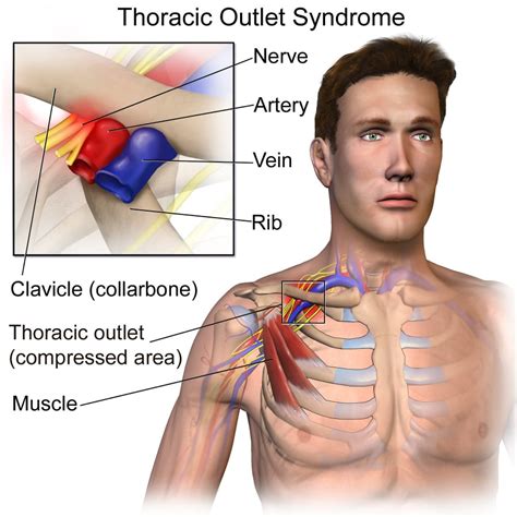 Roos Test For Thoracic Outlet Syndrome With Video