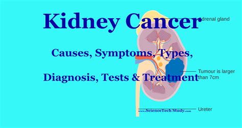 Kidney Cancer Symptoms Causes Diagnosis And Treatment Sciencetechstudy