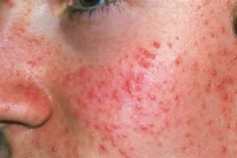 Acne On Face Treatcure