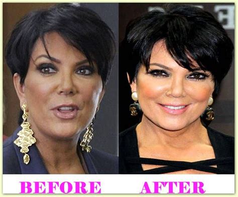 Kris Jenner Plastic Surgery