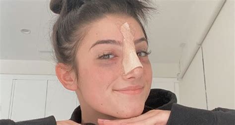 Charli Damelio Shares New Selfies Post Nose Surgery Charli Damelio