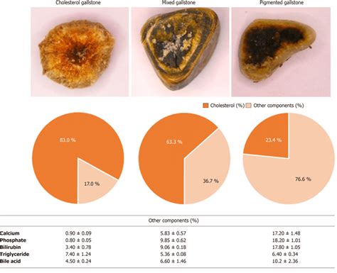 The Types Of Gallstones And The Compositions Of Gallstones Of Each