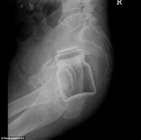 Doctors Share X Rays Of The Strangest Things Theyve Found Stuck In