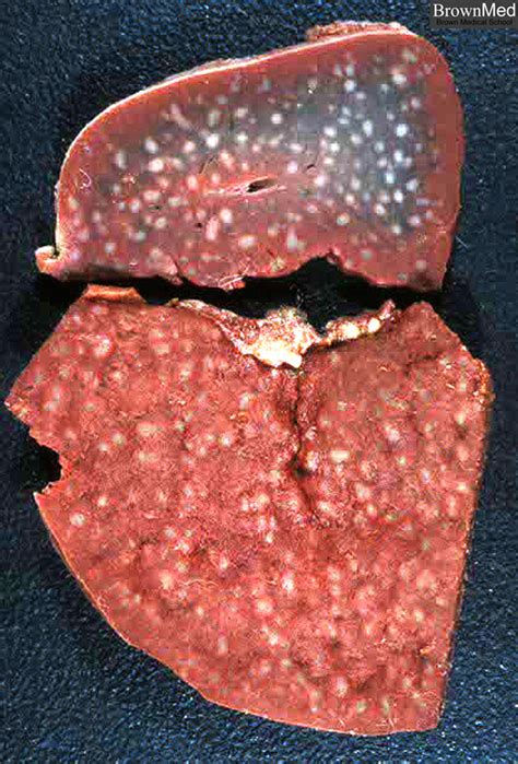 Sickle cell anemia