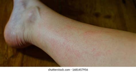 Terribly Itchy Skin Rash On Leg Foto Stok 1681457956 Shutterstock