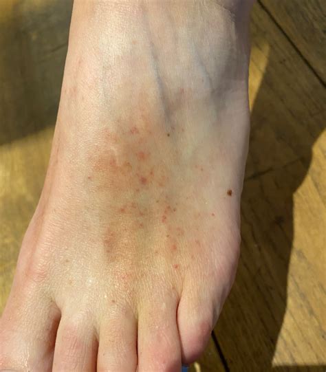 Diabetes Leg Rash