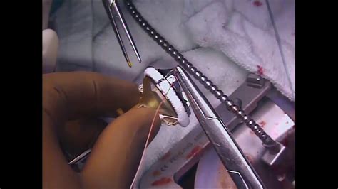 Mini Avr Open Heart Surgery Minimally Invasive Right Thoracotomy