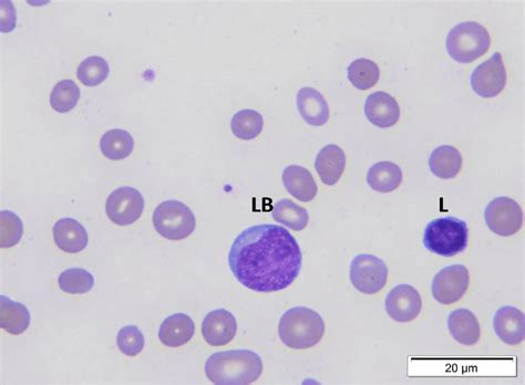 A Lymphoblast Lb And A Mature Lymphocyte L Note The Larger Size Of