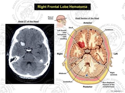 Right Frontal Lobe Hematoma