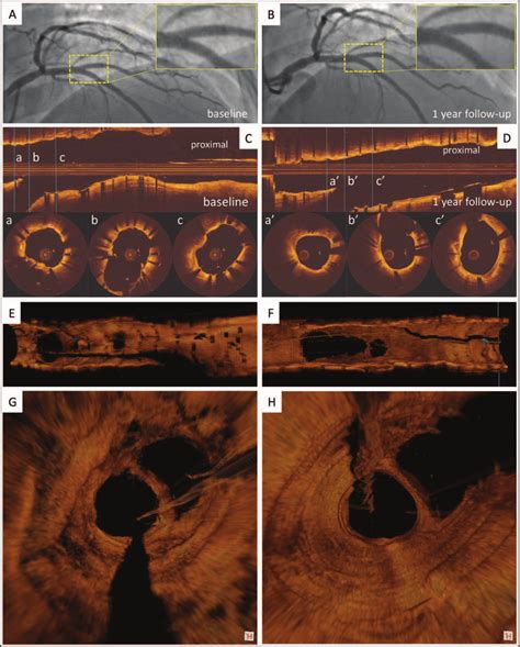 The Results Of Angiography And Oct Postprocedure And At 1 Year