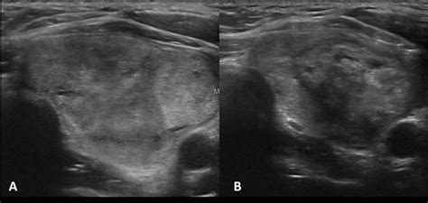 A Left Lobe Thyroid Nodule Treated By High Intensity Focused Ultrasound