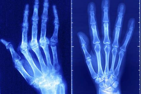Rheumatoid arthritis is a type of chronic (ongoing) arthritis that occurs in joints on both sides of the body (for instance, both hands, wrists, and/or knees). Hope for millions of arthritis sufferers as scientists ...
