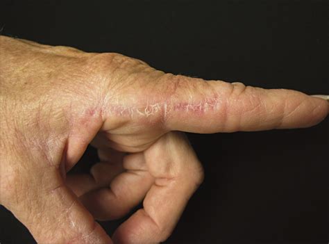 Asymptomatic Lesions On The Hands—quiz Case Dermatology Jama