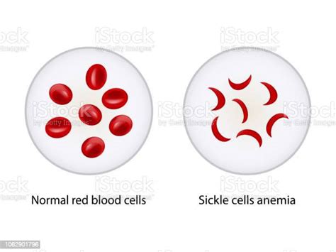 Comparison Between Normal Red Blood Cells And Sickle Cells Anemia Stock