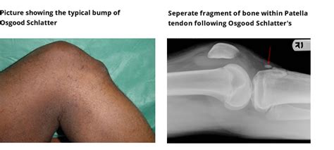 Tendinitis And Overuse Injuries Knee Surgeons And Specialists Yorkshire