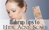 Makeup To Hide Acne Scars Images