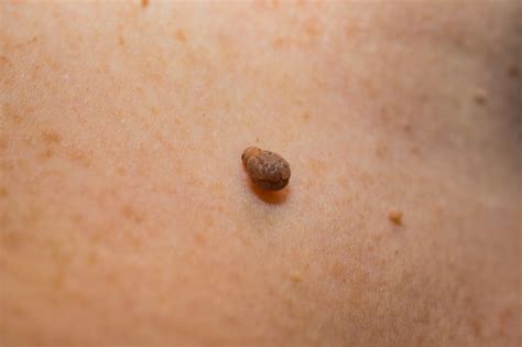 skin tag removal should you do it yourself the doctor weighs in