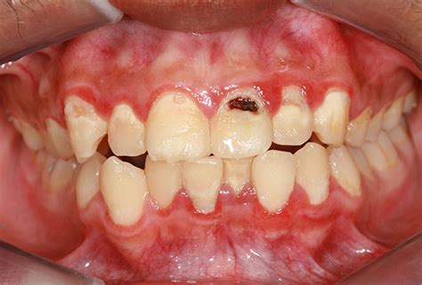 Oral Cancer Risk May Be Increased By Gum Disease Bacteria Docs