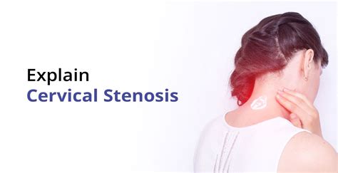 What Is Cervical Stenosis Birla Fertility And Ivf