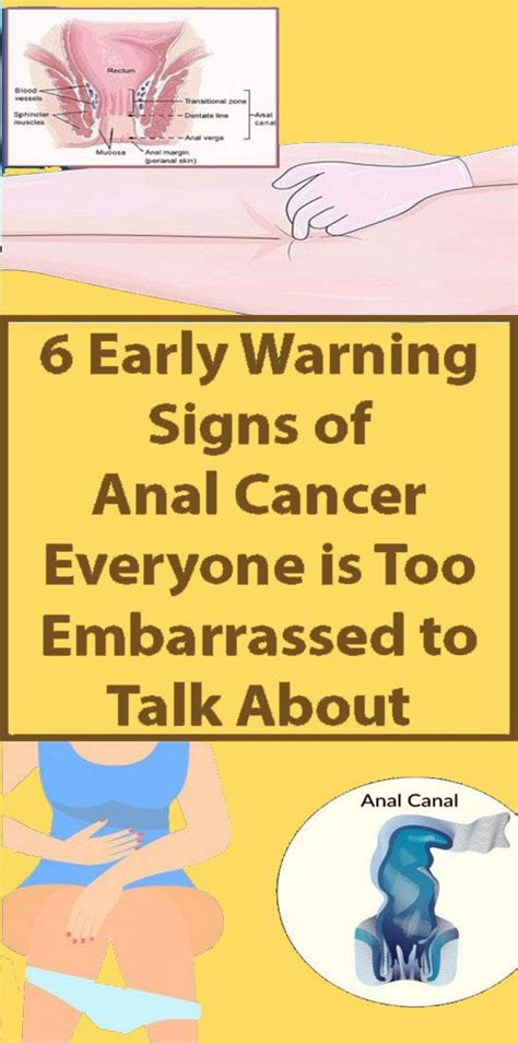 6 Unusual Signs Of Anal Cancer You Shouldn’t Ignore Wellness Hero
