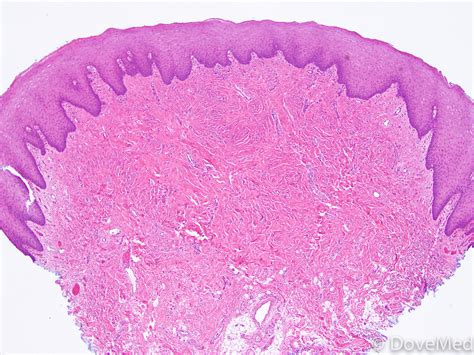 Oral Giant Cell Fibroma