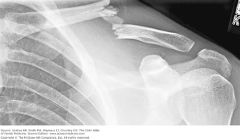 Clavicular Fracture Basicmedical Key