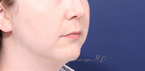 Buccal Fat Removal New Orleans Cheek Fat Removal New Orleans