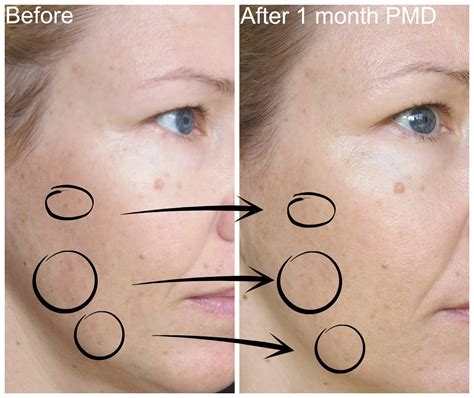 Pmd Personal Microderm 1 Month Update With Before After Pictures